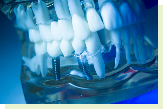 implant_image